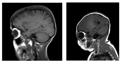 An MRI scan of the brain of an individual with normal (left) and mutated (right) versions of DONSON.